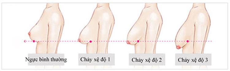 Tình trạng ngực chảy xệ sau sinh 1