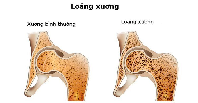 Loãng xương 1