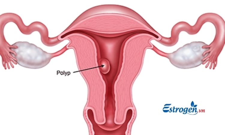 Polyp tử cung 1