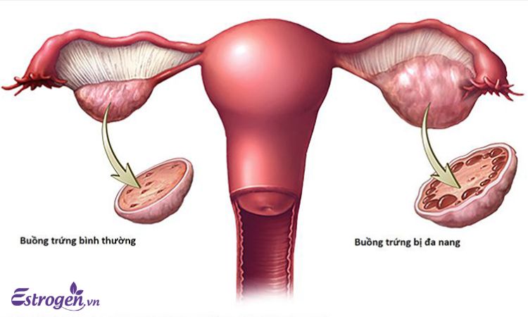 Mắc các bệnh lý về buồng trứng 1